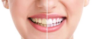 Teeth Whitening Before and After